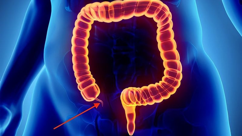 Các triệu chứng đi kèm như buồn nôn và sốt thường xuất hiện sau cơn đau bụng. 