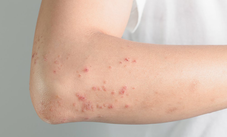 Người dùng nên sử dụng Calamine đúng cách để hạn chế kích ứng da 