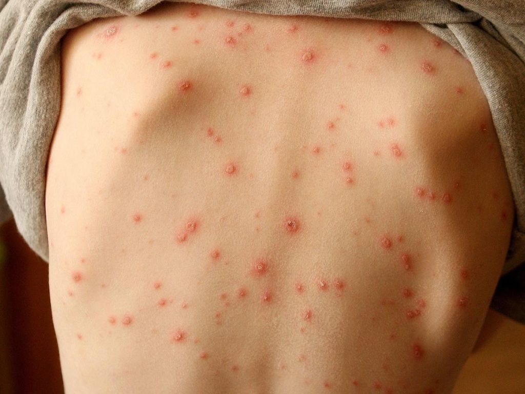 Việc quan sát kỹ đặc điểm các nốt mề đay giúp định hướng nguyên nhân chính xác