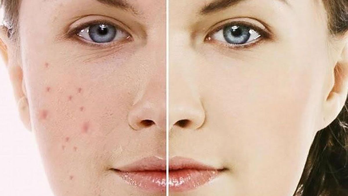 Hướng dẫn chọn kem trị mụn phù hợp: bí quyết loại bỏ mụn hiệu quả tại