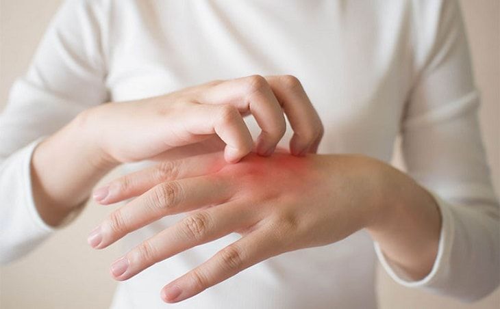 Minh hoạ về viêm khớp dạng thấp