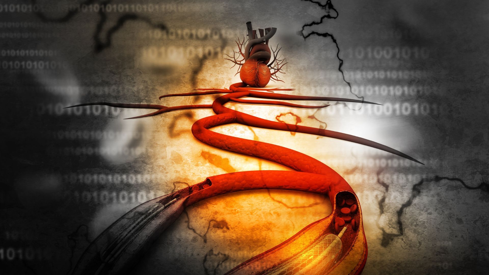 Minh họa hình ảnh stent