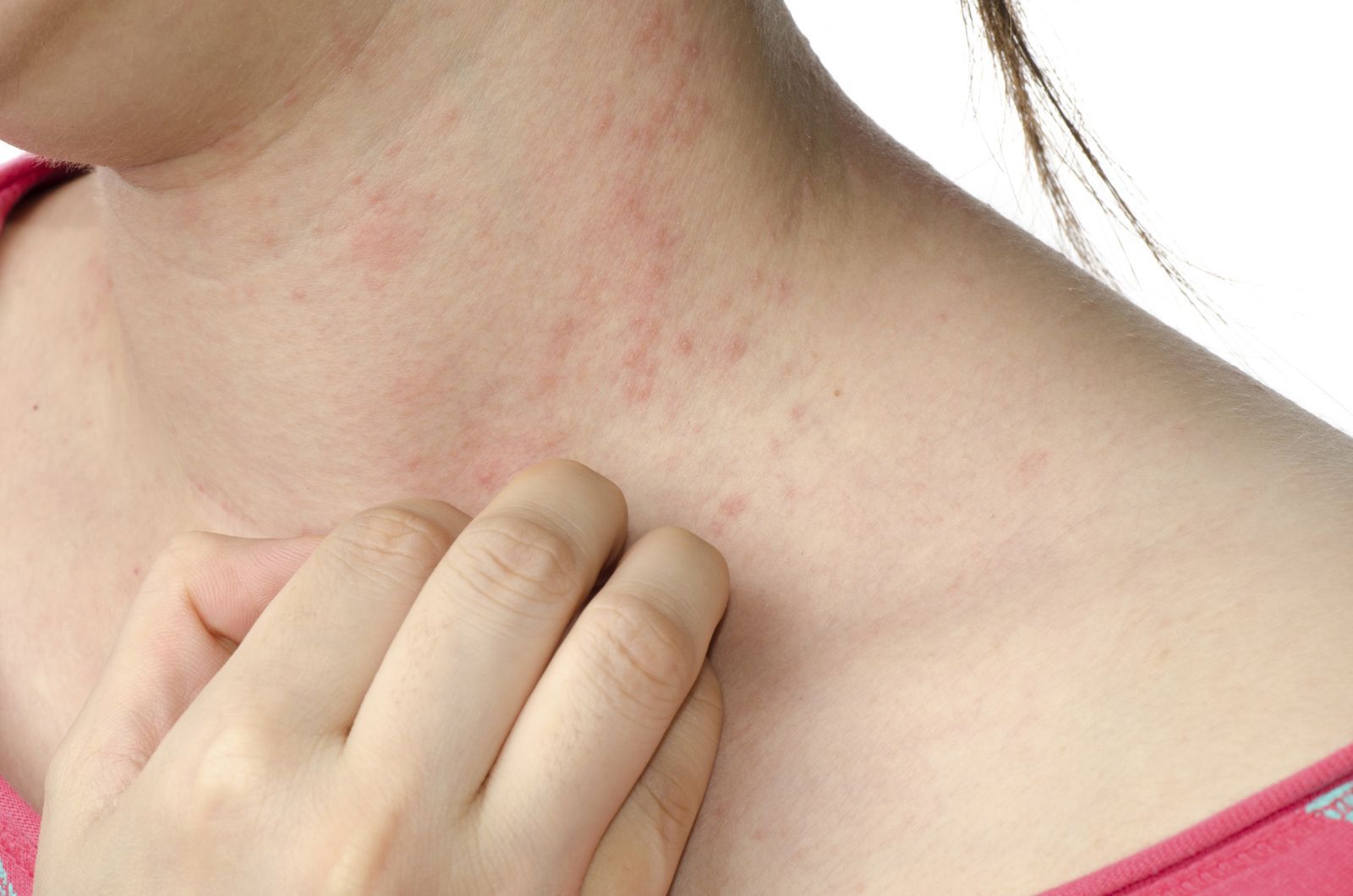 Viêm da tiếp xúc dị ứng có thể gây nổi mẩn đỏ và ngứa trên da