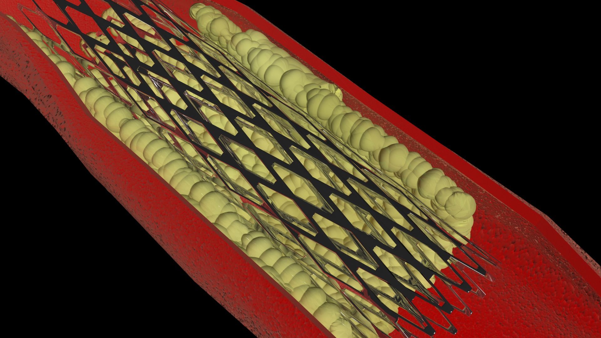 Thời gian can thiệp đóng vai trò quyết định hiệu quả của kỹ thuật đặt stent nhồi máu cơ tim