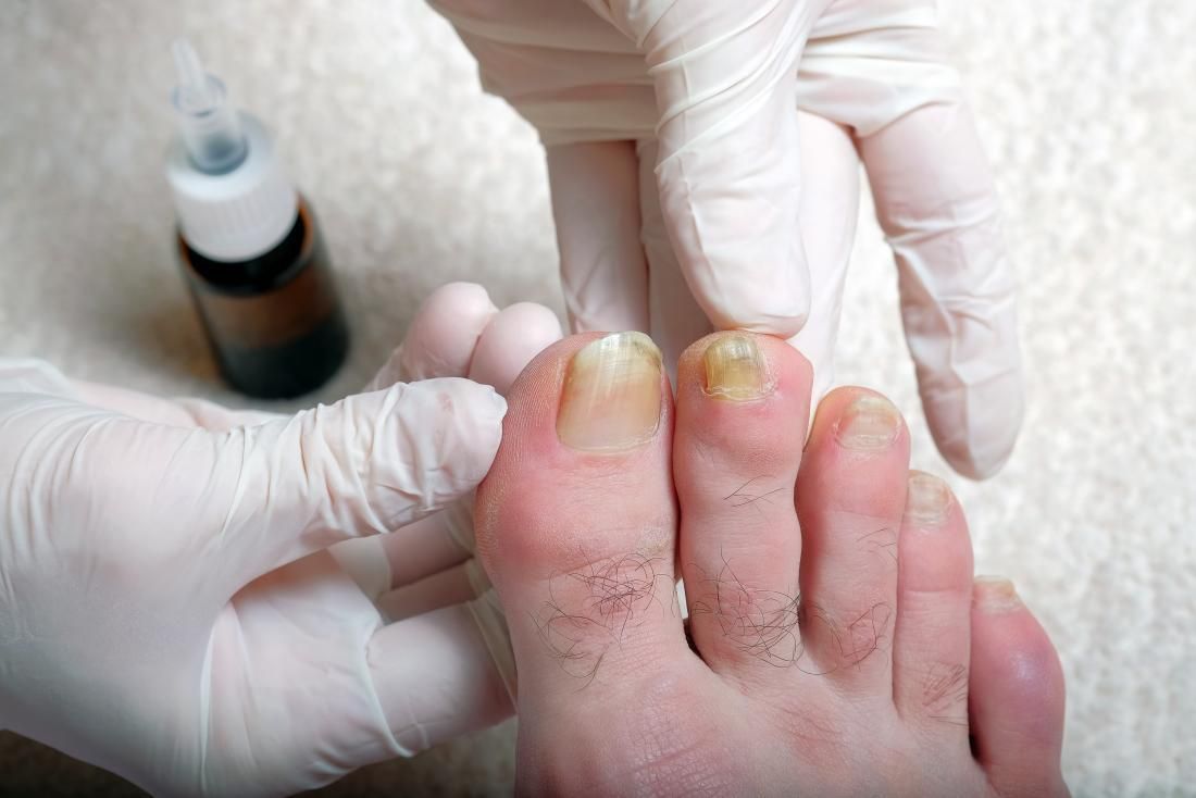 Vệ sinh và chăm sóc đúng cách giúp hỗ trợ giảm viêm và ngăn ngừa nhiễm trùng lan rộng.