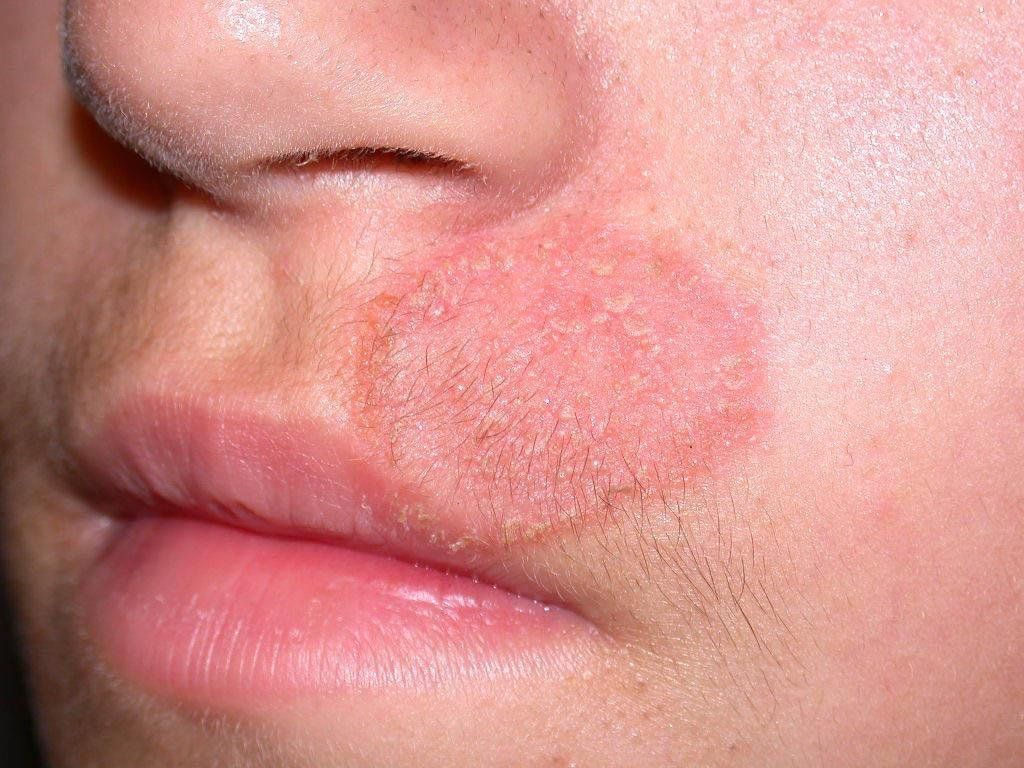 Viêm da tiếp xúc có thể gây nổi mẩn đỏ thành mảng trên da.