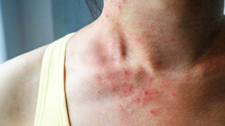 Minh hoạ về mảng da sẫn, nốt đỏ phù nề mề đay