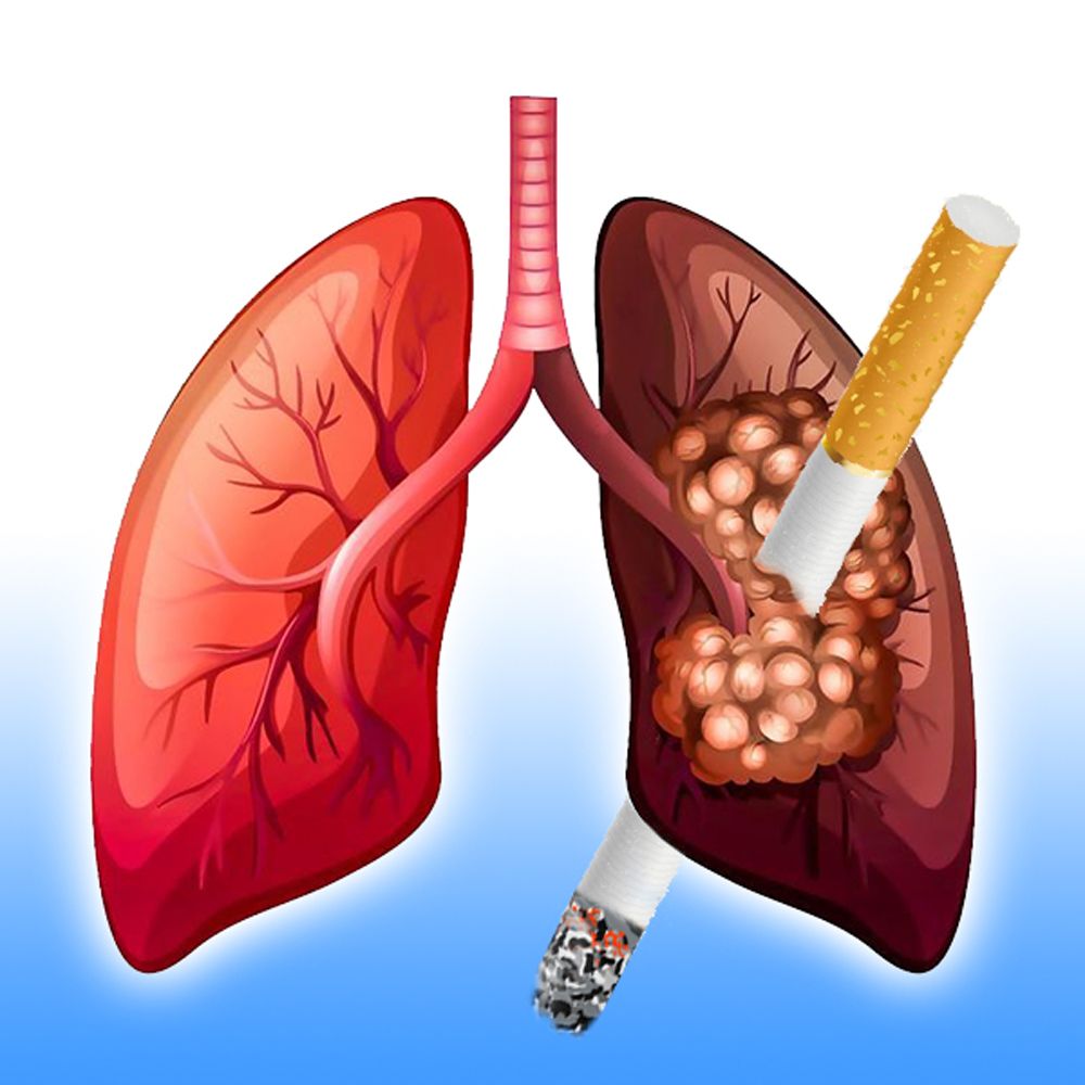 Minh hoạ về tình trạng COPD ở phổi