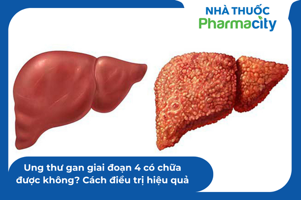 UNG THƯ GAN GIAI ĐOẠN 3 KHỐI U LỚN XÂM LẤN MẠCH MÁU TRONG GAN