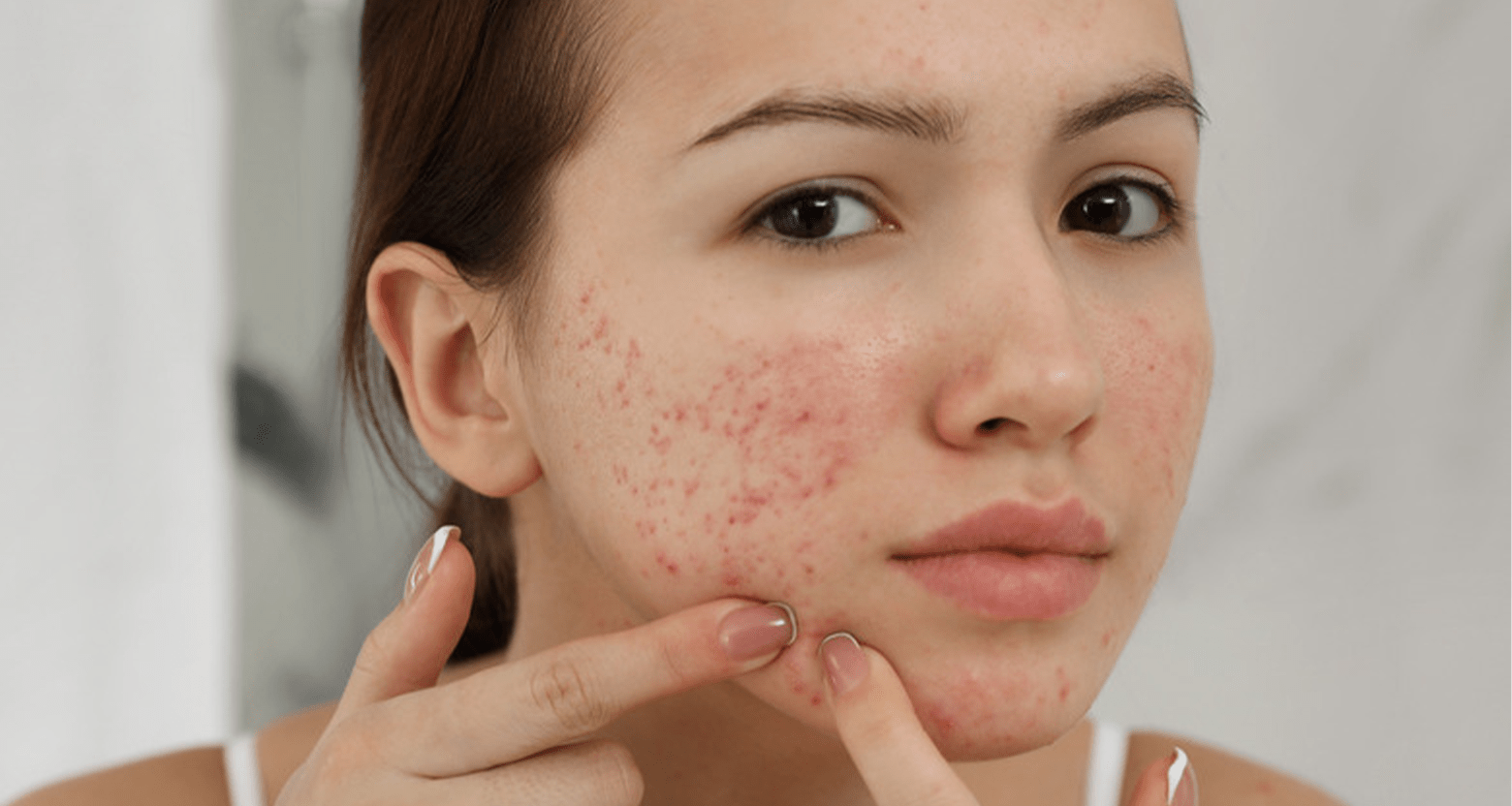Mụn nhọt và mẩn ngứa thường là biểu hiện của tình trạng nóng trong và chức năng gan suy giảm 