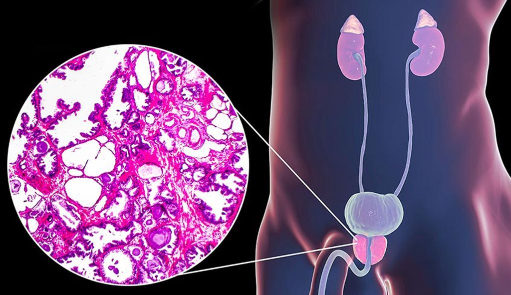 Phì đại và viêm là những vấn đề nam giới thường gặp khi bước sang tuổi trung niên 