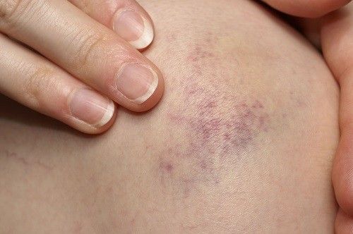 Để phân biệt sốt xuất huyết, hãy kéo căng da: nốt đỏ không biến mất là xuất huyết.