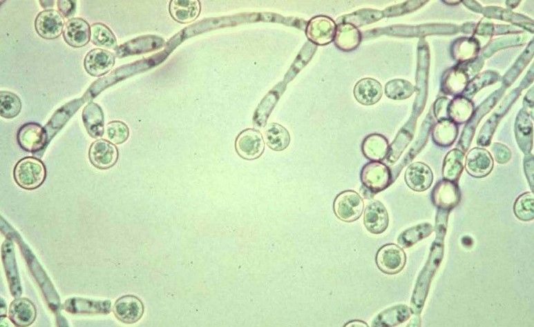 Tình trạng mệt mỏi kéo dài, sụt cân là triệu chứng điển hình HIV giai đoạn cuối