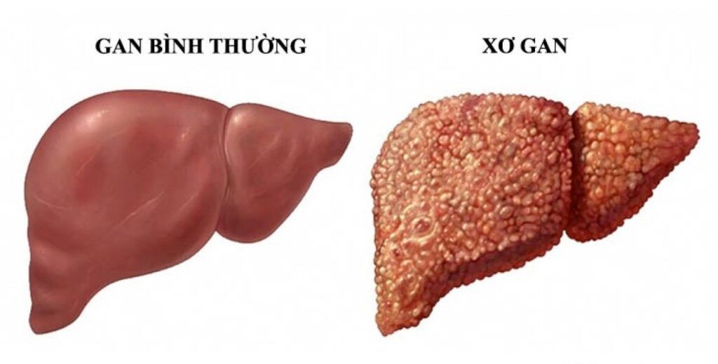 Minh hoạ về virus viêm gan B
