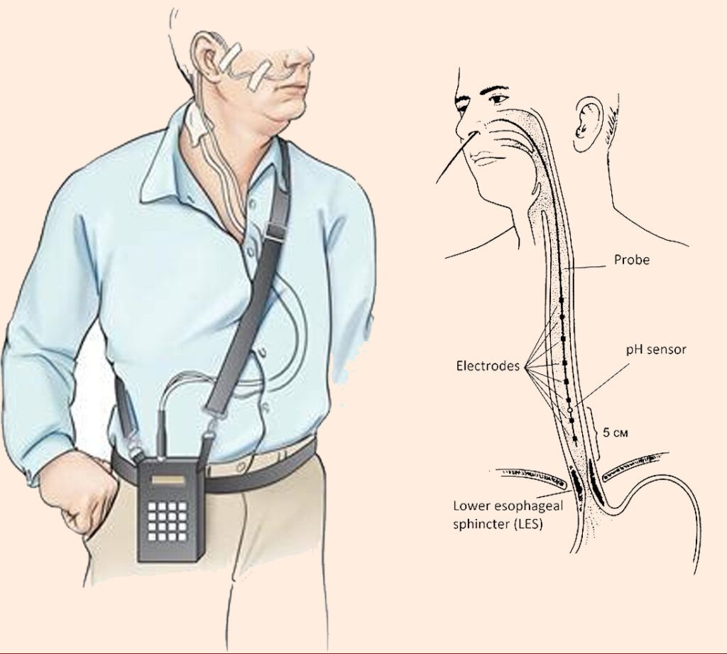 Hình minh họa xét nghiệm dạ dày