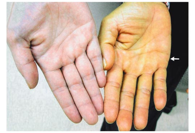 Gan đóng vai trò then chốt trong việc điều hòa nồng độ lipid trong dòng máu 