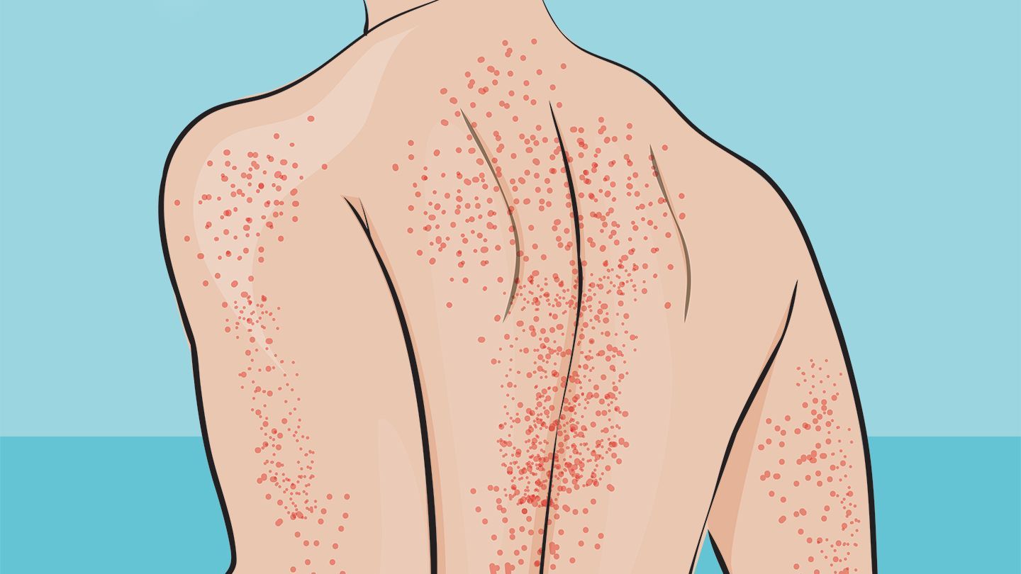 Các chấm xuất huyết dưới da có thể liên quan đến tình trạng giảm tiểu cầu trong máu 