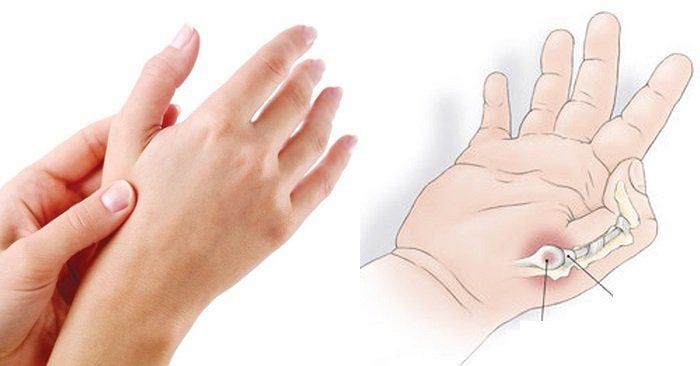 Tập phục hồi chức năng giúp cải thiện khả năng vận động của ngón tay sau chấn thương