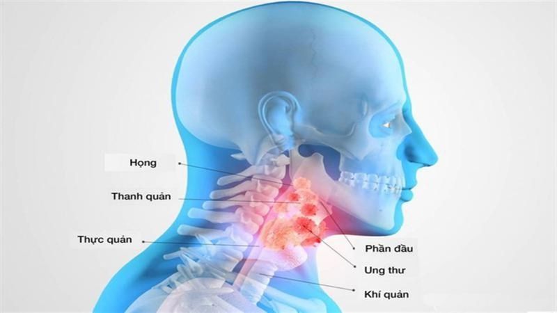 Xạ phẫu dao Gamma là kỹ thuật hiện đại giúp kiểm soát khối u di căn trong não