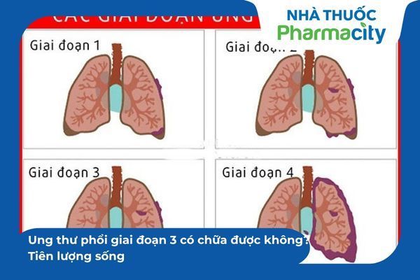 Xác định đúng giai đoạn bệnh là cơ sở để lựa chọn phác đồ điều trị