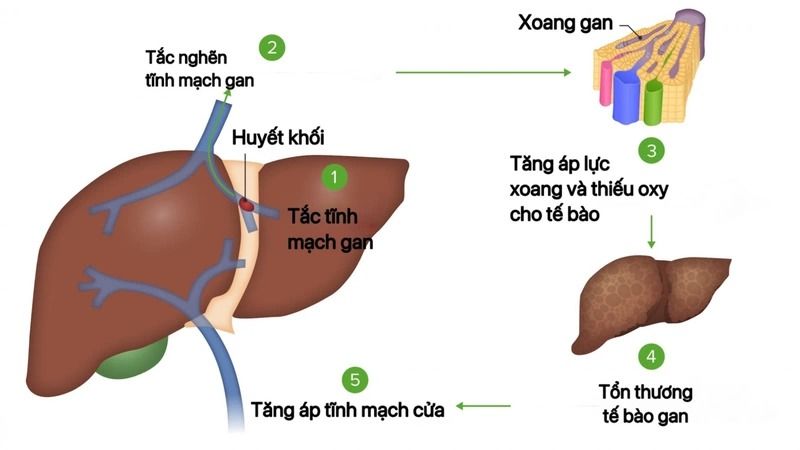 Minh hoạ về các chỉ số xét nghiệm khi sốt xuất huyết biến chứng vào gan