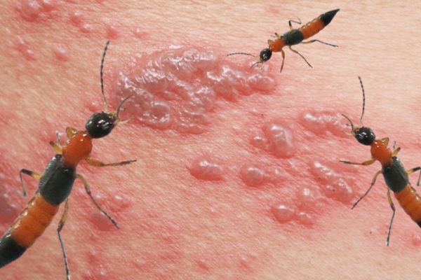 Kiến ba khoang (tên khoa học là Paederus fuscipes) 