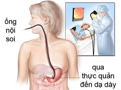 Hình minh họa dấu hiệu trào ngược dạ dày