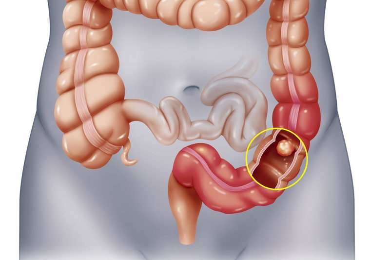 THỜI GIAN SỐNG CỦA BỆNH NHÂN UNG THƯ TRỰC TRÀNG GIAI ĐOẠN CUỐI PHỤ THUỘC NHIỀU VÀO ĐÁP ỨNG ĐIỀU TRỊ