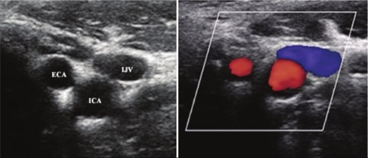 Chụp MRI hoặc siêu âm động mạch cảnh là những kỹ thuật cốt lõi trong tầm soát đột quỵ 