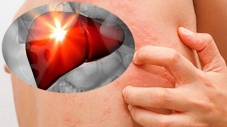 Lưu ý khi nghi ngờ nổi mụn do gan 
