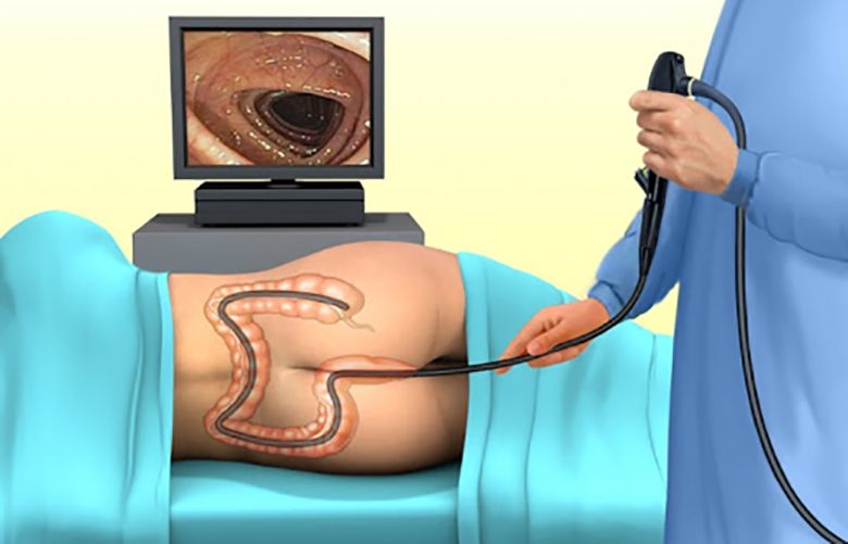 Nội soi đại tràng là phương pháp quan trọng để chẩn đoán chính xác giai đoạn bệnh 