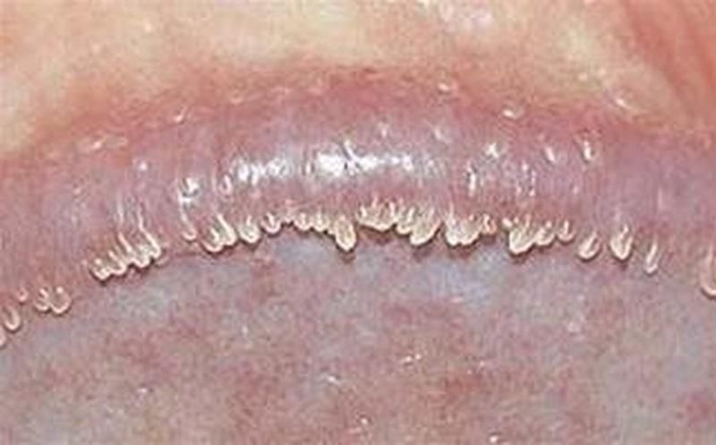 Vệ sinh vùng kín đúng cách giúp giảm nguy cơ cậu nhỏ nổi mụn trắng không ngứa