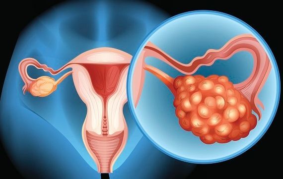 Các giai đoạn của ung thư buồng trứng giai đoạn 2 
