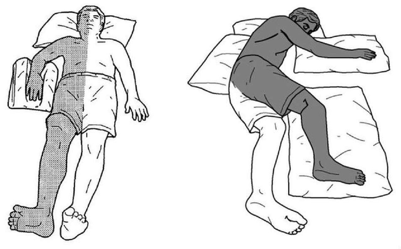 Dấu hiệu tê bì, yếu liệt một bên cơ thể diễn tiến rất nhanh và đột ngột