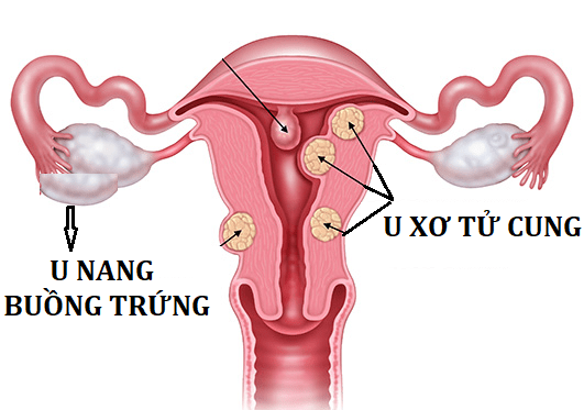 U xơ tử cung và u nang buồng trứng 