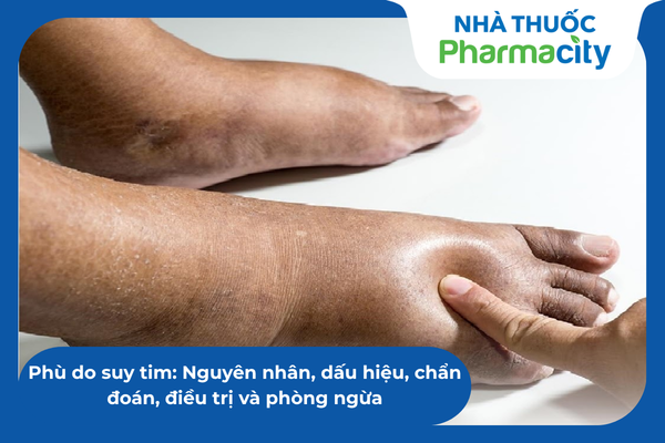 Phù do suy tim: Nguyên nhân, dấu hiệu, chẩn đoán, điều trị và phòng ngừa