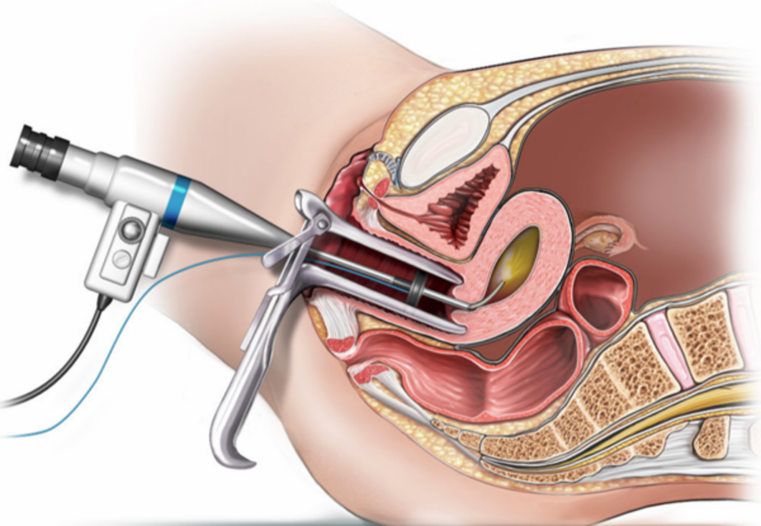 Quy trình điều trị polyp thường nhẹ nhàng và nhanh chóng 