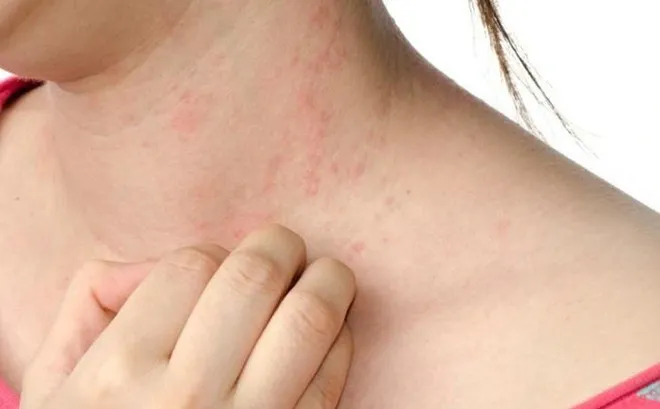 Điều trị viêm da dị ứng