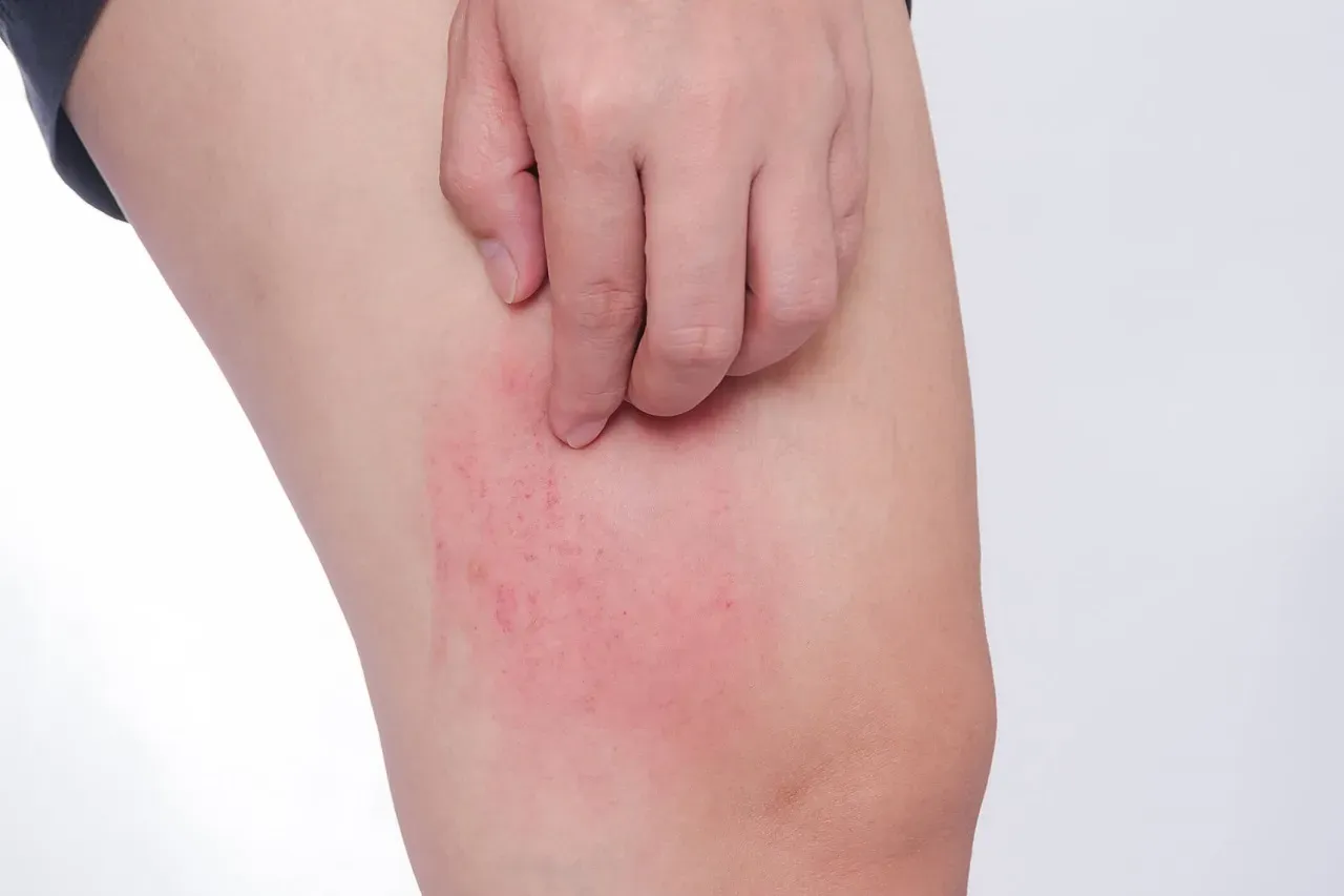 Khi xuất hiện các dấu hiệu dị ứng như phát ban, nổi mề đay, cần ngưng dùng thuốc Acemuc ngay lập tức