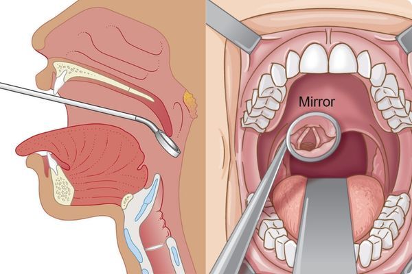 Thăm khám bác sĩ ngay khi có dấu hiệu tổn thương thanh quản