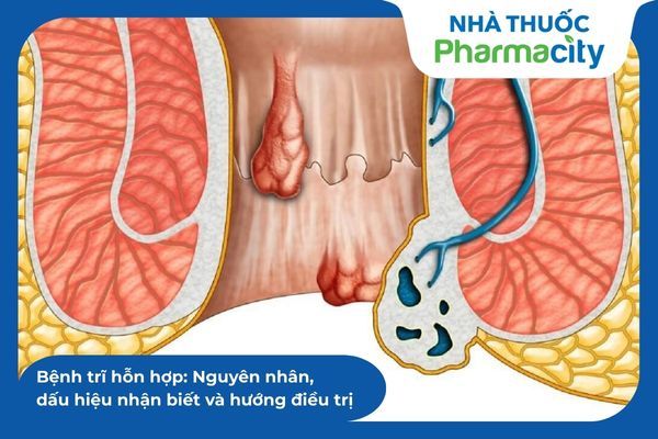 Khám chuyên khoa giúp phân loại mức độ trĩ để có phương pháp can thiệp phù hợp 