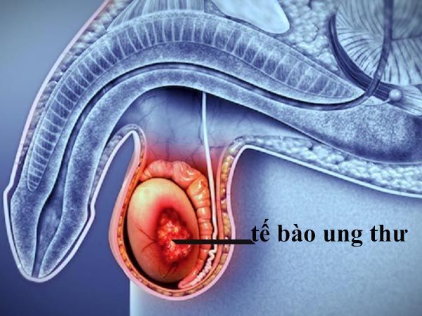 Nam giới cần chú ý đến các thay đổi bất thường ở vùng bìu để phát hiện bệnh sớm 