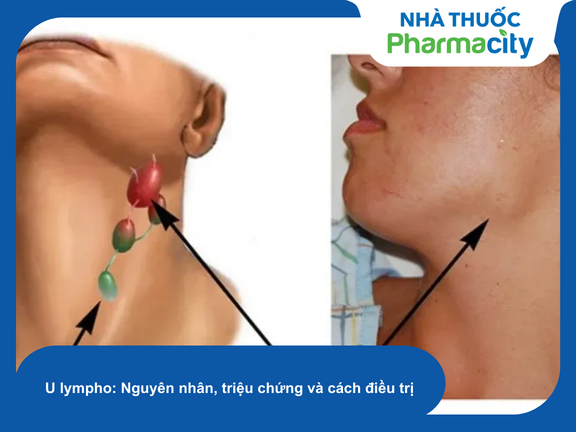 Kiểm tra hạch vùng cổ là thao tác lâm sàng quan trọng để chẩn đoán u lympho