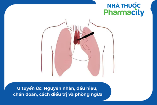 U tuyến ức: Nguyên nhân, dấu hiệu, chẩn đoán, cách điều trị và phòng ngừa