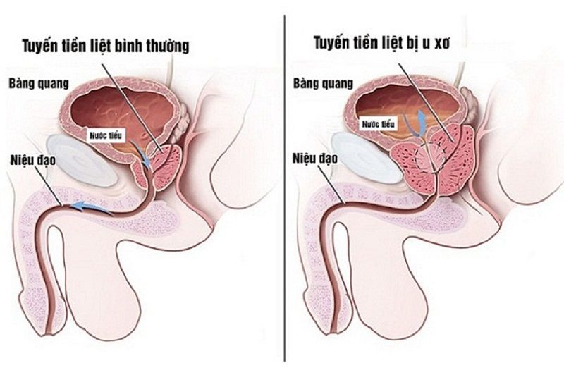 Các triệu chứng bất thường về đường tiểu ở nam giới lớn tuổi có thể là dấu hiệu cảnh báo bệnh lý tại tuyến tiền liệt. 