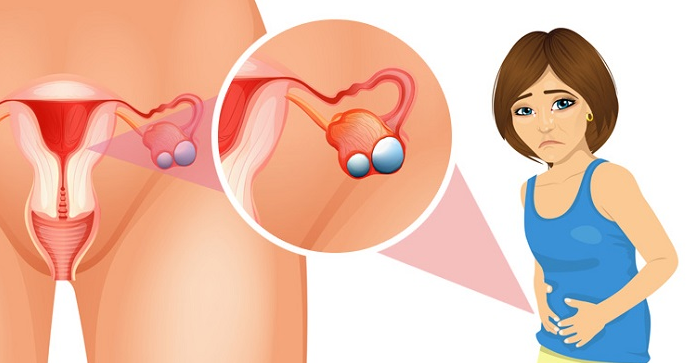 Sử dụng các thiết bị kiểm tra sức khỏe tại nhà kết hợp với lịch khám định kỳ giúp phụ nữ chủ động theo dõi những thay đổi nhỏ nhất của cơ thể khi mắc u nang buồng trứng