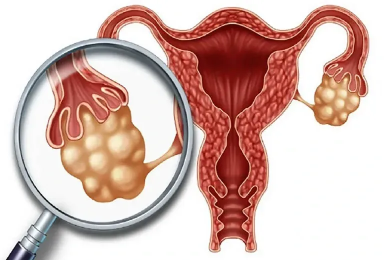 Bản thân khối u ác tính ở buồng trứng không lây truyền hay di căn sang thai nhi