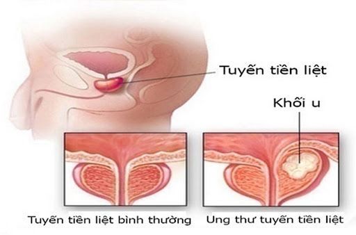Ung thư tuyến liệt do khối u bất thường gây ra