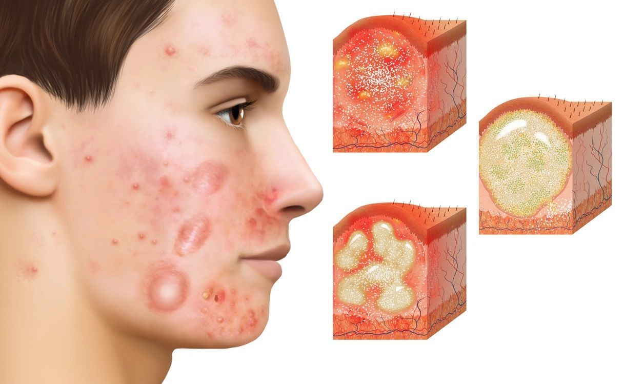 Viêm da mụn mủ truyền nhiễm