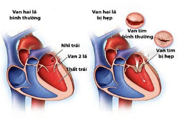 Vì sao hẹp van 2 lá gây suy tim phải? Phân biệt suy tim phải và suy tim ...